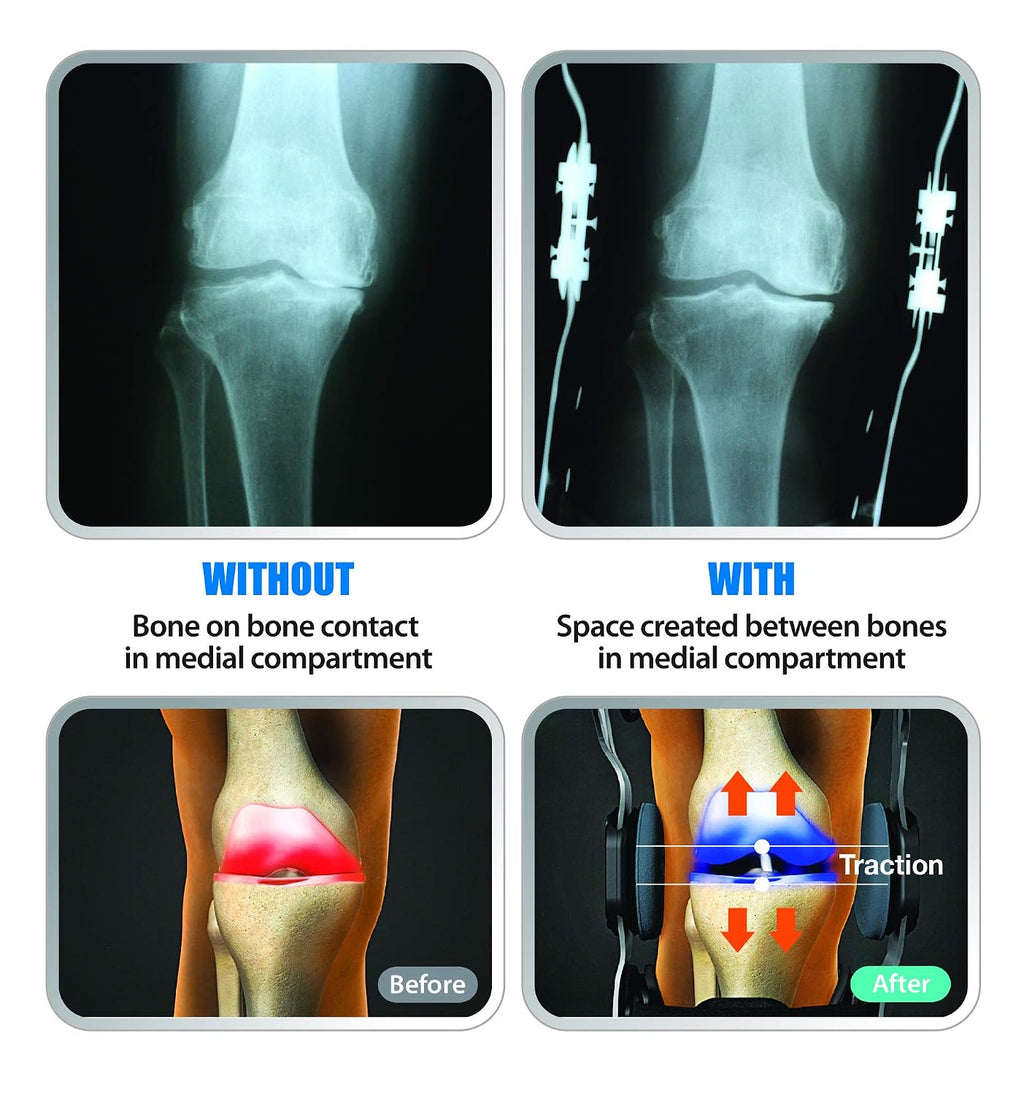 DDS, Inc. OA Pro Decompression Knee Braces - Arthritis Knee Support for Degeneration, Meniscus Tear, Bone-on-Bone Pressure Relief - Dual Unloading for Medial & Lateral Stability (Small)